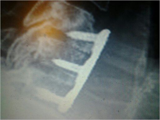 Neck fusion left compressed spinal cord